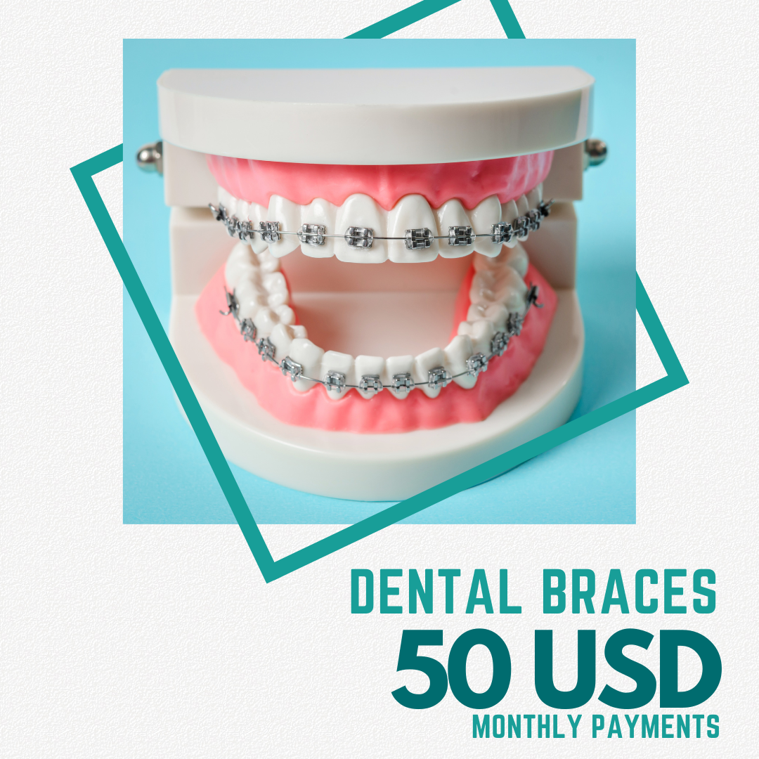 Dental Braces in Tijuana, Financial Plans from 50 USD